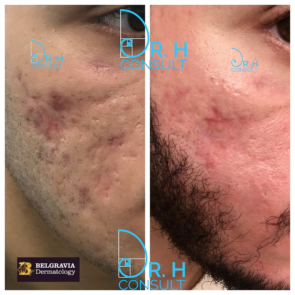 Acne Scar Laser Treatment Removal London Dr H Consult