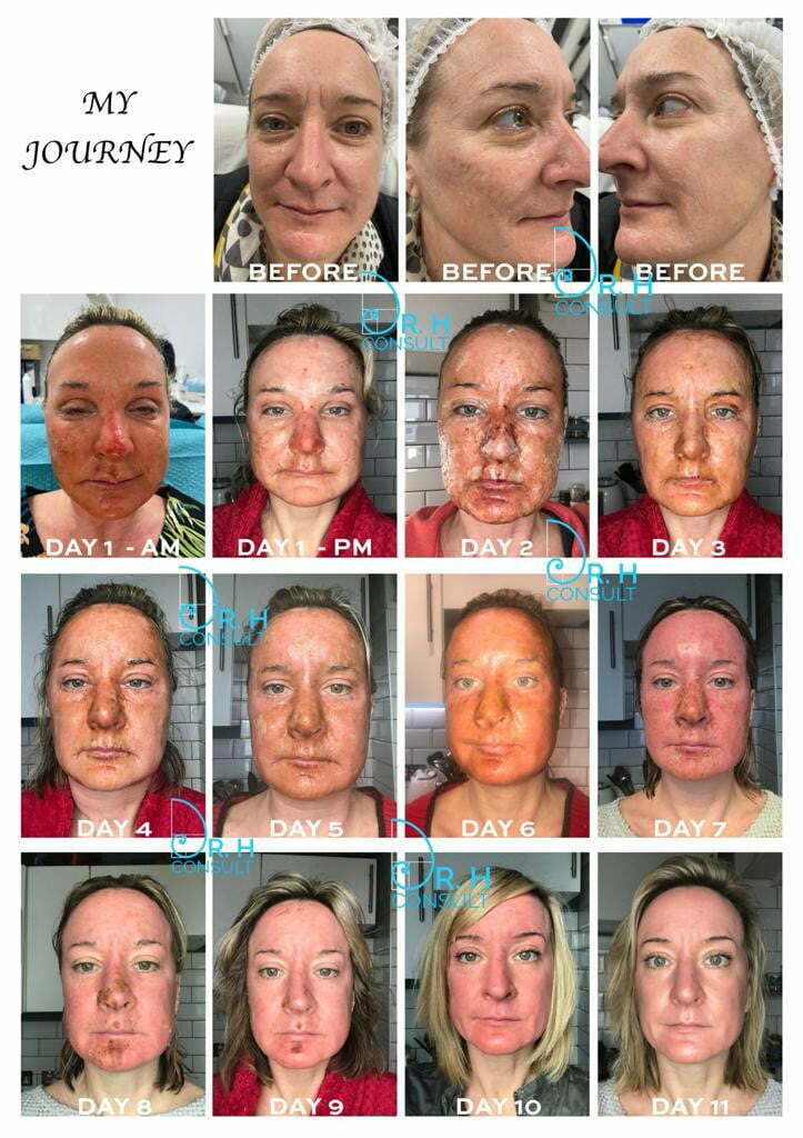 Pre and post procedure photographs of fractional CO2 laser withprp patients